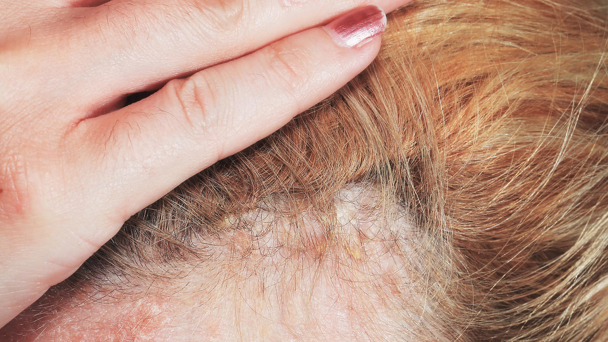 łojotokowe zapalenie skóry głowy szampon z antybiotykiem