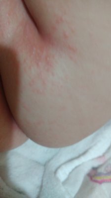 alergia na pampersy
